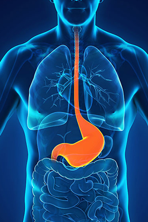 Acid Reflux
